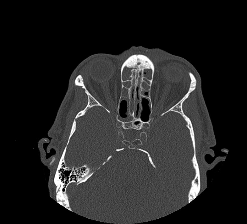 Aplastic maxillary sinuses (Radiopaedia 60030-67561 Axial non-contrast 50).jpg