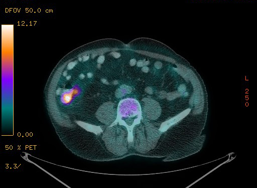 Appendiceal adenocarcinoma complicated by retroperitoneal abscess (Radiopaedia 58007-65041 Axial PET-CT 145).jpg