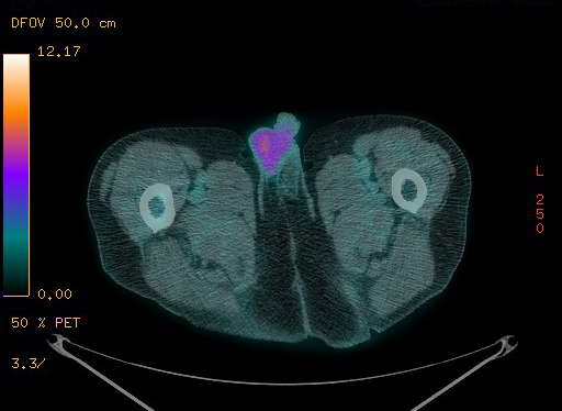 Appendiceal adenocarcinoma complicated by retroperitoneal abscess (Radiopaedia 58007-65041 Axial PET-CT 209).jpg