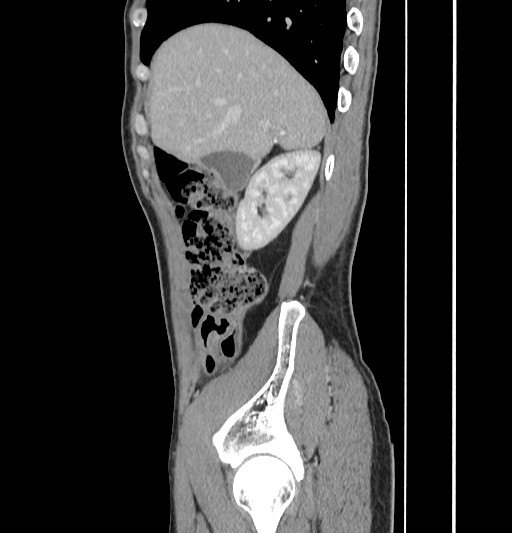 Appendiceal mucinous adenocarcinoma (Radiopaedia 66605-75922 C 14).jpg