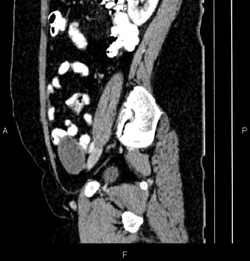 Appendiceal mucocele (Radiopaedia 83147-97518 D 32).jpg
