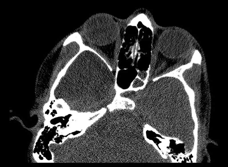 Arachnoid cyst- extremely large (Radiopaedia 68741-78450 Axial bone window 20).jpg
