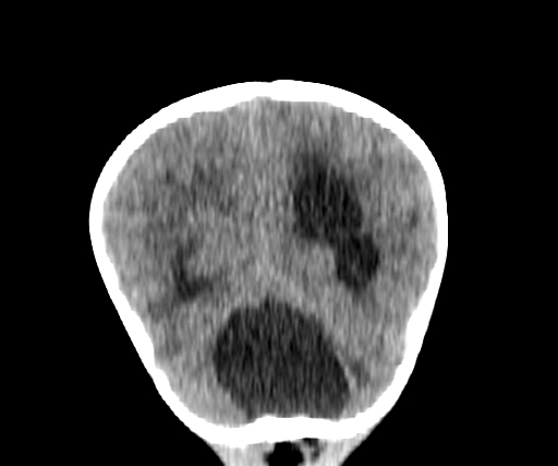 Arachnoid cyst-posterior fossa (Radiopaedia 88661-105370 Coronal non-contrast 61).jpg