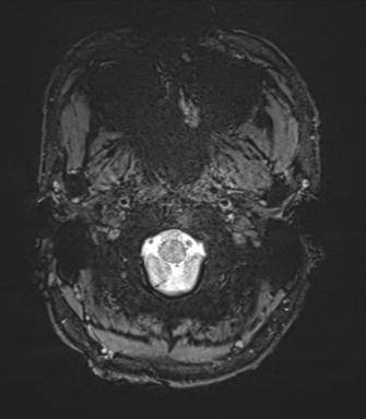 Arachnoid cyst with subdural hematoma (Radiopaedia 85892-101743 Axial SWI 1).png