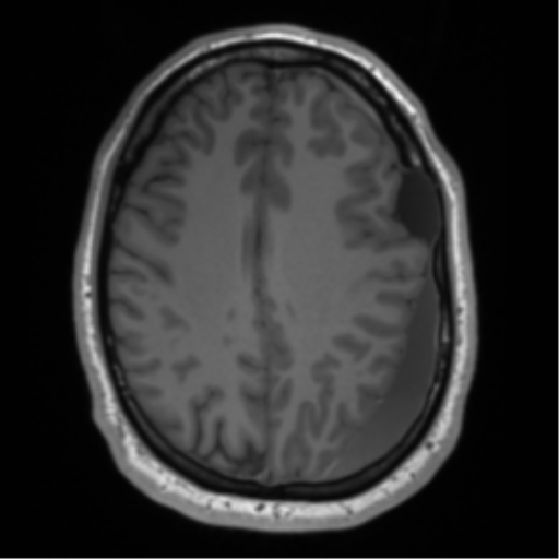 File:Arachnoid cyst with subdural hematoma (Radiopaedia 85892-101743 Axial T1 60).png