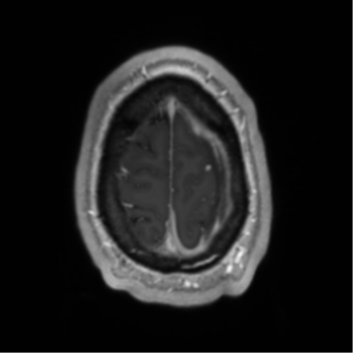 Arachnoid cyst with subdural hematoma (Radiopaedia 85892-101743 Axial T1 C+ 75).png