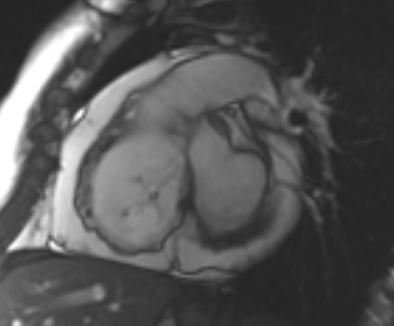 File:Arrhythmogenic right ventricular cardiomyopathy (Radiopaedia 69431-79307 Short axis cine 186).jpg