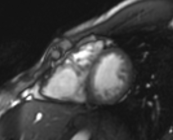 Arrhythmogenic right ventricular cardiomyopathy (Radiopaedia 69564-79464 short axis cine 110).jpg