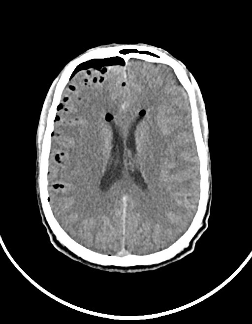 Arrow injury to the brain (Radiopaedia 72101-82607 Axial non-contrast 76).jpg