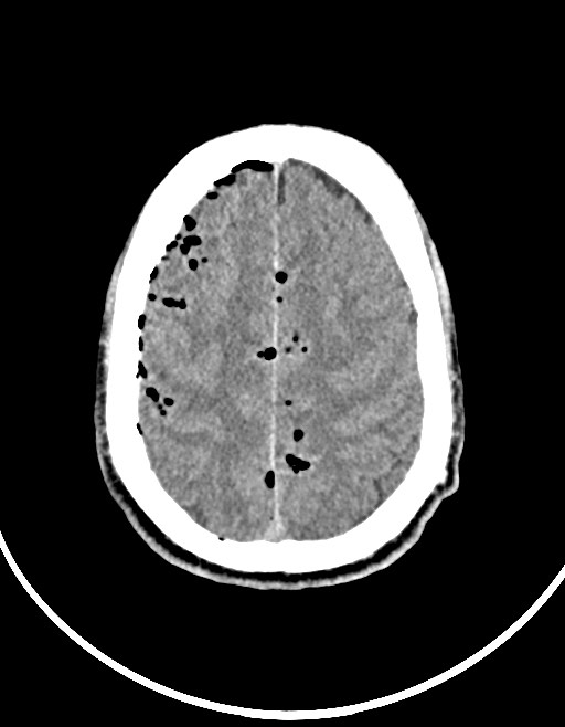 Arrow injury to the brain (Radiopaedia 72101-82607 Axial non-contrast 84).jpg