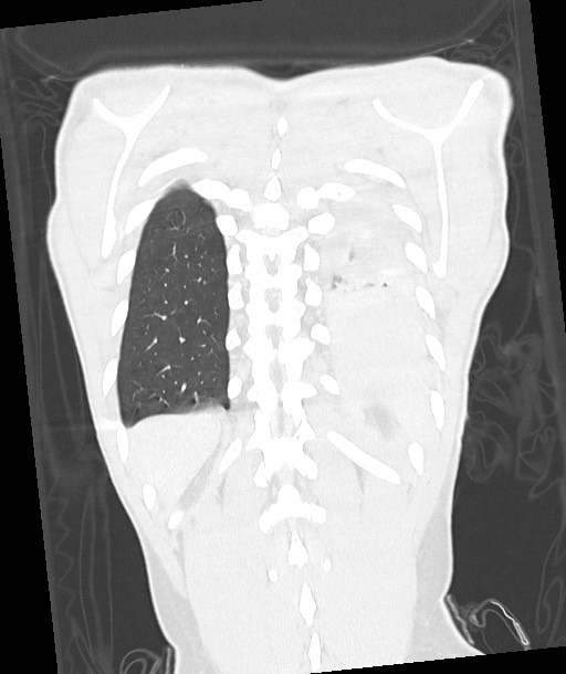 Arrow injury to the chest (Radiopaedia 85367-100975 Coronal lung window 109).jpg
