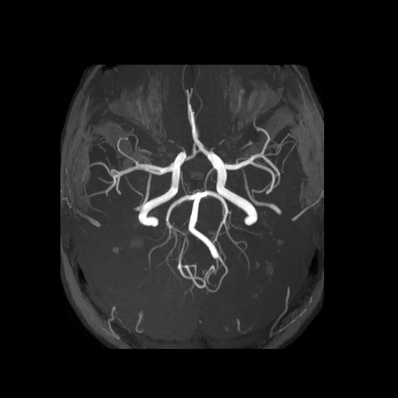 Artery of Percheron infarct (Radiopaedia 40966-43676 F 24).jpg