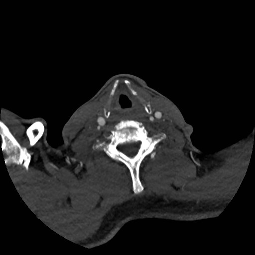 File:Artery of Percheron infarct (Radiopaedia 48088-52894 A 49).jpg