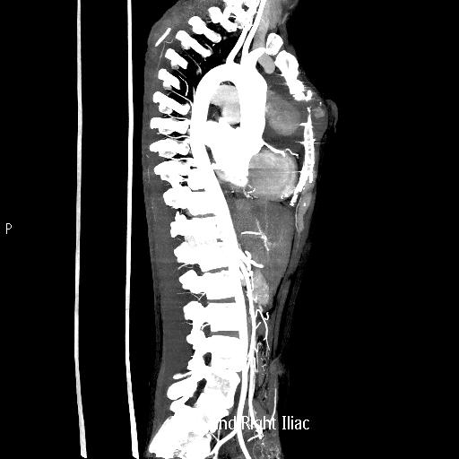 File:Ascending aortic pseudoaneurysm (Radiopaedia 28638-28910 Sagittal MIP 1).jpg