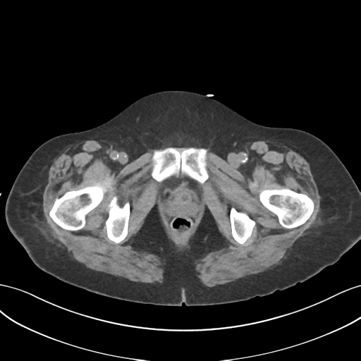File:Ascending cholangitis (Radiopaedia 39068-41253 Axial non-contrast 69).png