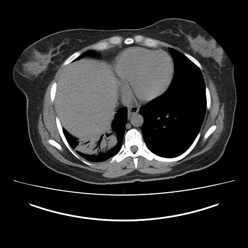 Ascending retrocecal appendicitis with liver abscesses (Radiopaedia 60066-67615 Axial non-contrast 5).jpg