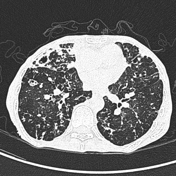 File:Aspergilloma- with Monod sign (Radiopaedia 44737-48532 Axial lung window 162).jpg
