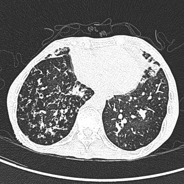 Aspergilloma- with Monod sign (Radiopaedia 44737-48532 Axial lung window 203).jpg
