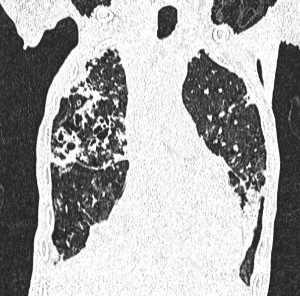 Aspergilloma- with Monod sign (Radiopaedia 44737-48532 Coronal lung window 192).jpg