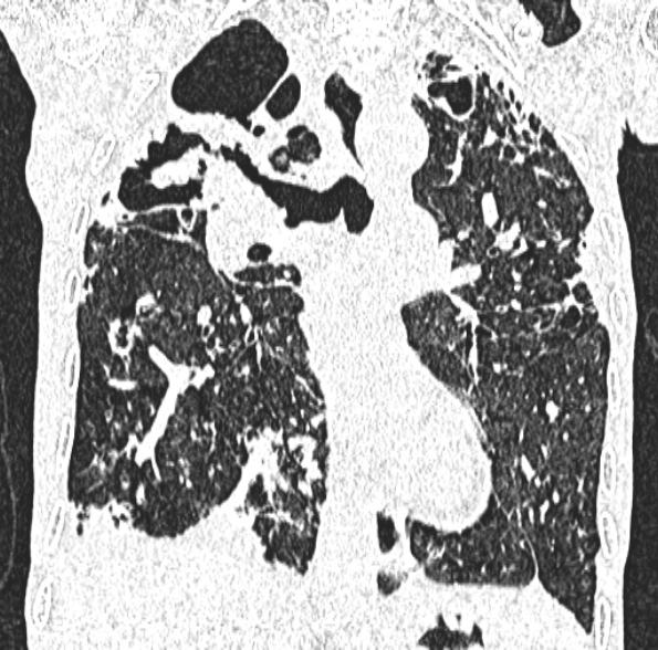 Aspergilloma- with Monod sign (Radiopaedia 44737-48532 Coronal lung window 248).jpg