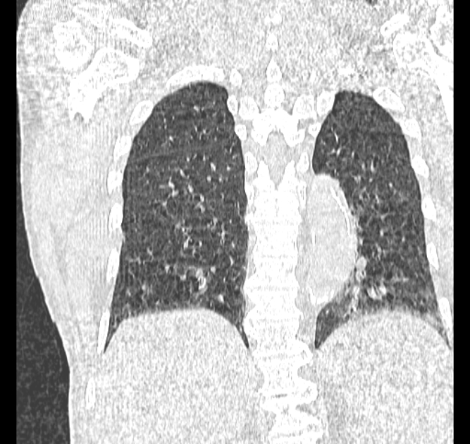 Aspergilloma (Radiopaedia 44592-48327 Coronal lung window 98).jpg