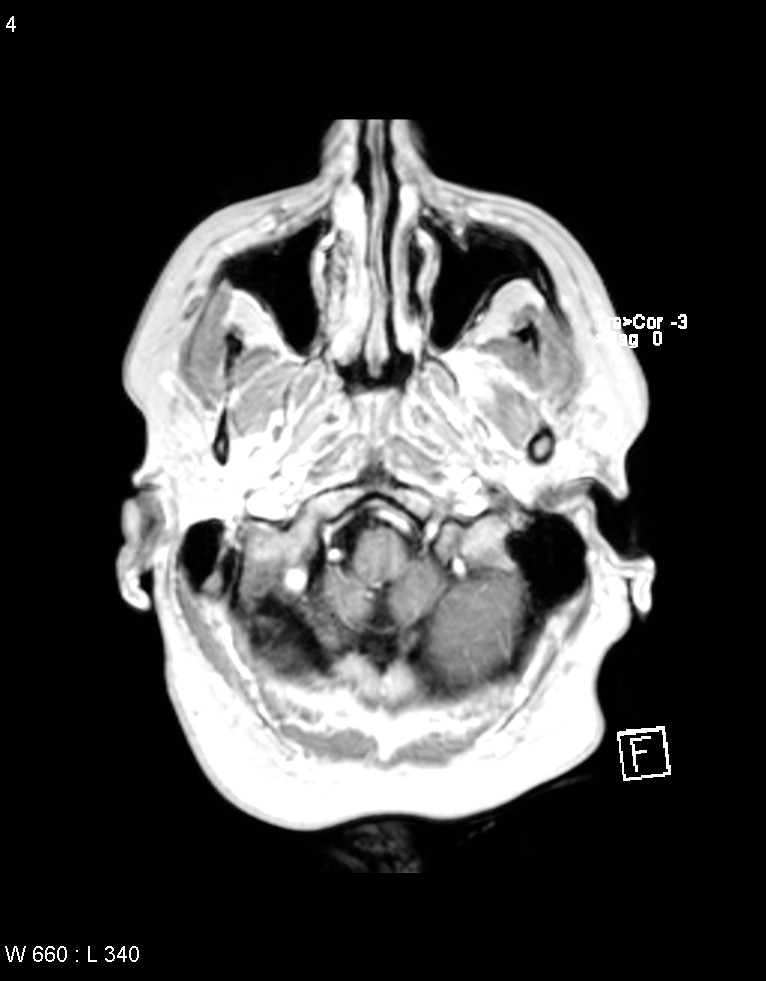 Astroblastoma (Radiopaedia 39792-42218 Axial T1 C+ 3).jpg