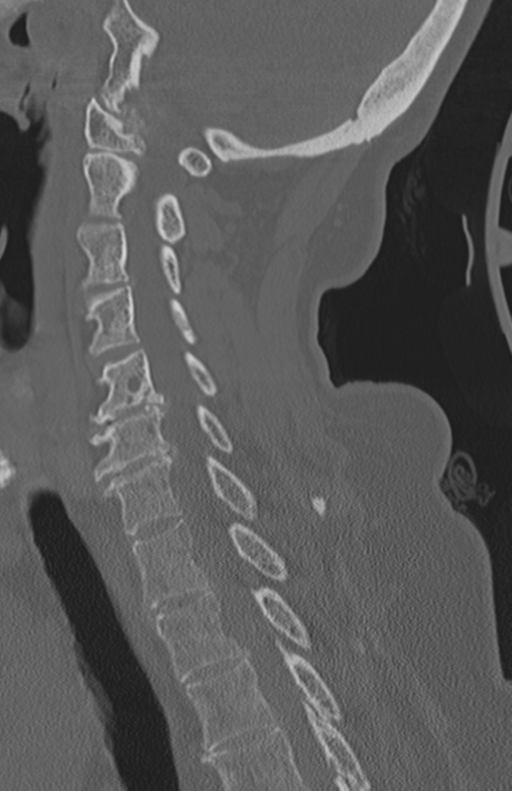 Atlanto-axial subluxation (Radiopaedia 36610-38176 Sagittal bone window 47).png