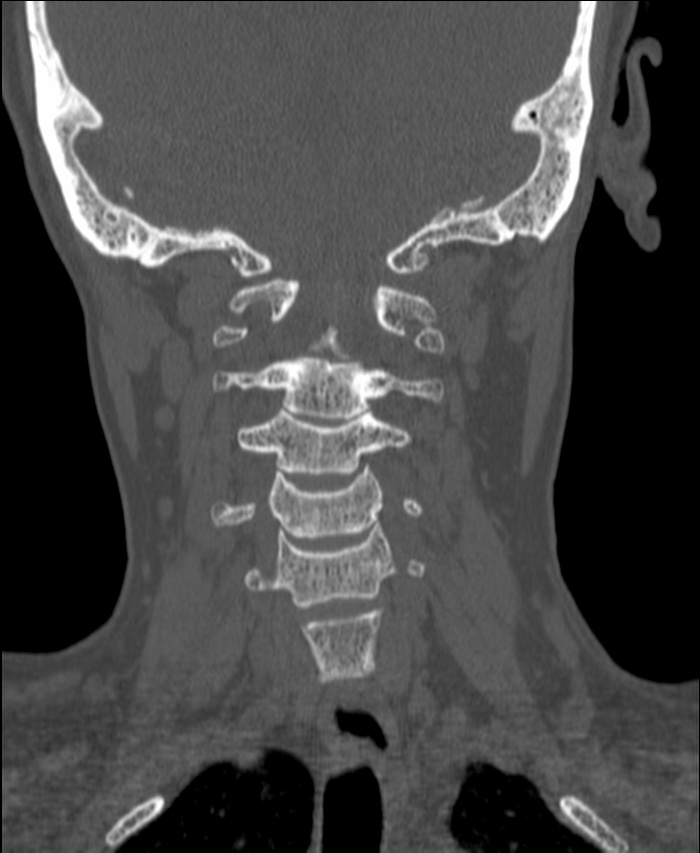 Atlanto-occipital assimilation with basilar invagination (Radiopaedia 70122-80188 Coronal bone window 110).jpg