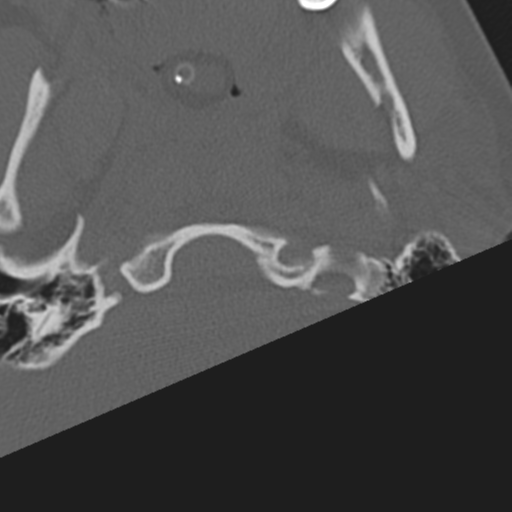 File:Atlanto-occipital dissociation (Radiopaedia 33848-35013 Axial bone window 2).png