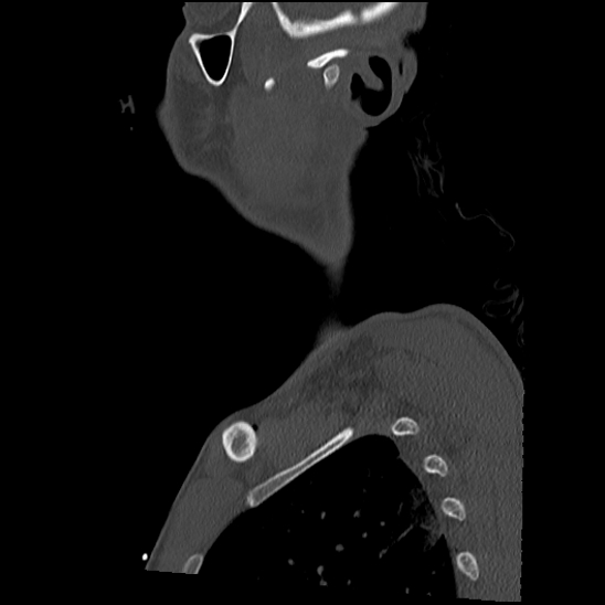 File:Atlanto-occipital dissociation (Traynelis type 1), C2 teardrop fracture, C6-7 facet joint dislocation (Radiopaedia 87655-104061 Sagittal bone window 3).jpg