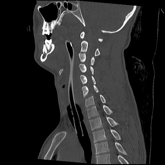 Atlanto-occipital dissociation (Traynelis type 1), C2 teardrop fracture, C6-7 facet joint dislocation (Radiopaedia 87655-104061 Sagittal bone window 33).jpg