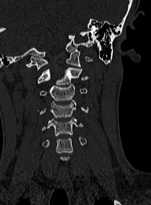 Atlantoaxial subluxation (Radiopaedia 44681-48450 Coronal bone window 46).jpg