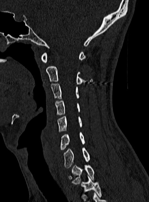 Atlantoaxial subluxation (Radiopaedia 44681-48450 Sagittal bone window 51).jpg