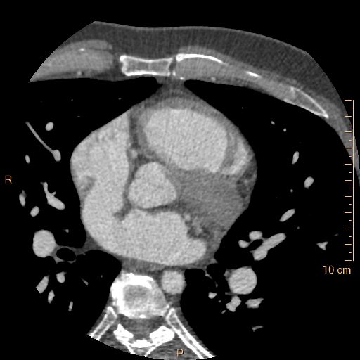 Atrial septal defect (upper sinus venosus type) with partial anomalous pulmonary venous return into superior vena cava (Radiopaedia 73228-83961 A 110).jpg