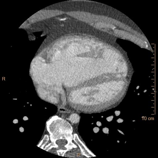 Atrial septal defect (upper sinus venosus type) with partial anomalous pulmonary venous return into superior vena cava (Radiopaedia 73228-83961 A 194).jpg