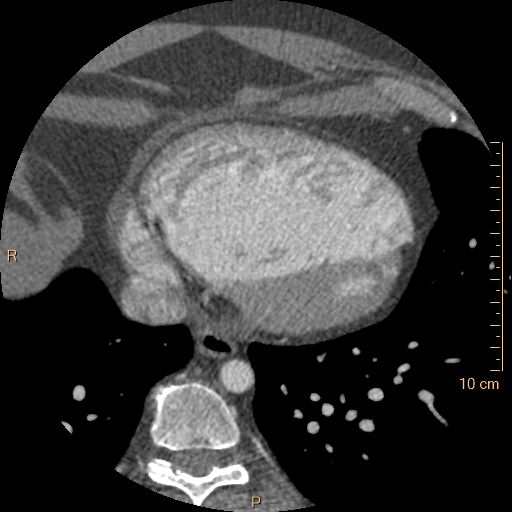 Atrial septal defect (upper sinus venosus type) with partial anomalous pulmonary venous return into superior vena cava (Radiopaedia 73228-83961 A 217).jpg