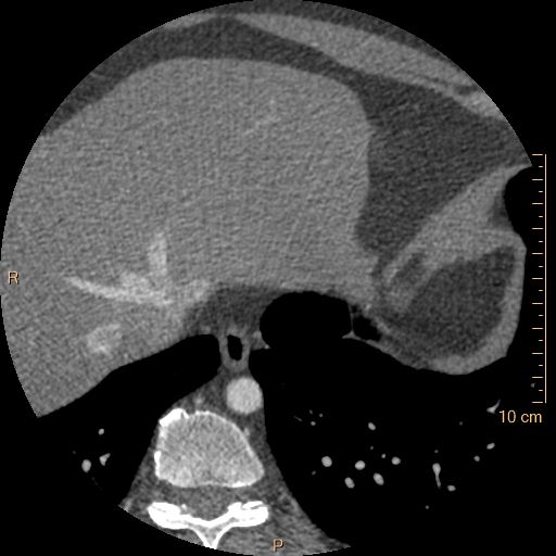 Atrial septal defect (upper sinus venosus type) with partial anomalous pulmonary venous return into superior vena cava (Radiopaedia 73228-83961 A 262).jpg