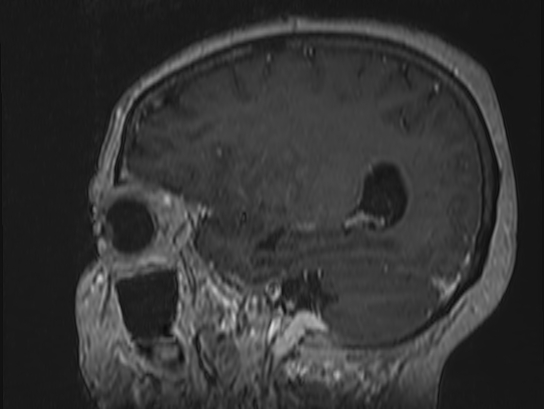 Atypical meningioma (Radiopaedia 62985-71406 Sagittal T1 C+ 23).jpg