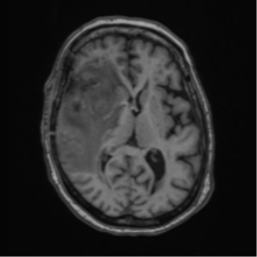 Atypical meningioma (WHO Grade II) (Radiopaedia 54742-60981 Axial T1 36).png