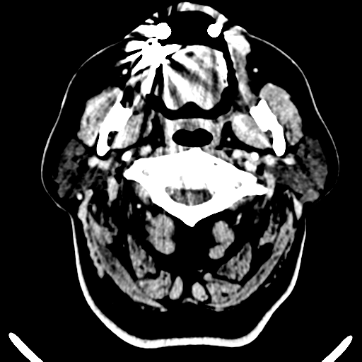 Atypical meningioma (WHO grade II) with brain invasion (Radiopaedia 57767-64728 Axial C+ 58).png