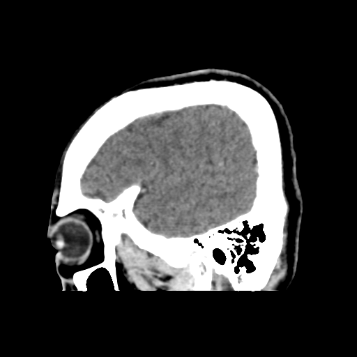 Atypical meningioma (WHO grade II) with osseous invasion (Radiopaedia 53654-59715 G 10).png