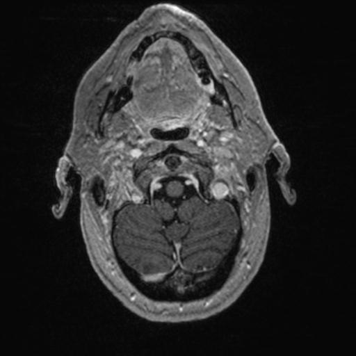 Atypical meningioma (grade II) - en plaque (Radiopaedia 29633-30147 Axial T1 C+ 25).jpg