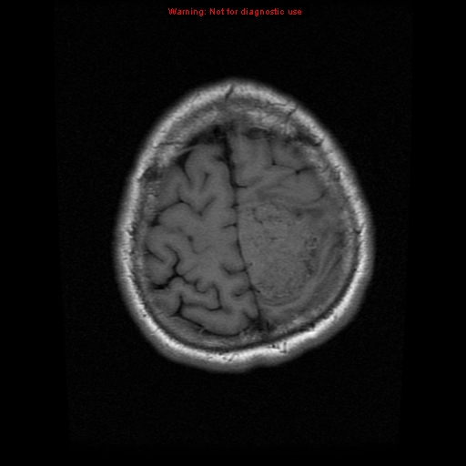 File:Atypical meningioma - grade II (Radiopaedia 13303-13305 Axial T1 19).jpg