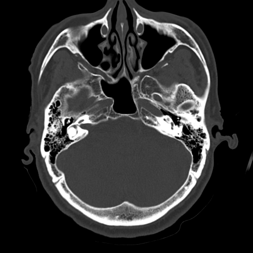 Atypical meningioma with skull invasion (Radiopaedia 34357-35649 Axial bone window 21).png