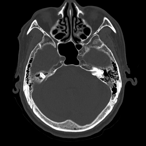 Atypical meningioma with skull invasion (Radiopaedia 34357-35649 Axial bone window 24).png