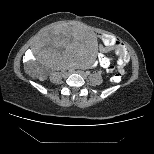 File:Atypical retroperitoneal lymphocoeles with large leiomyoma of uterus (Radiopaedia 32084-33024 A 25).jpg