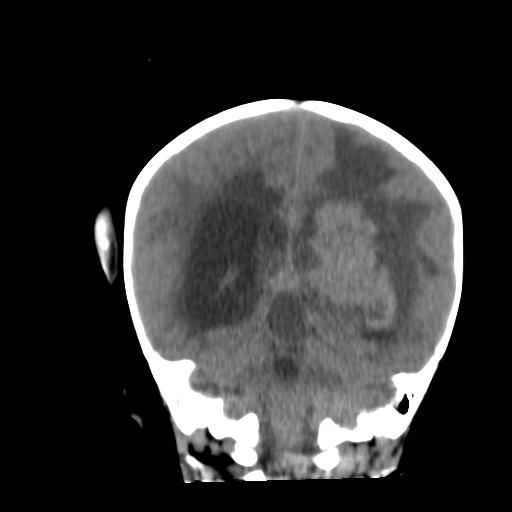 Atypical teratoid rhabdoid tumor (AT-RT) (Radiopaedia 85823-101654 Coronal non-contrast 35).jpg