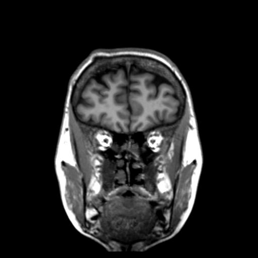 Autoimmune limbic encephalitis (Radiopaedia 30363-31005 Coronal T1 45).jpg
