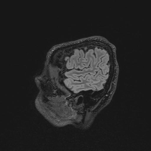 Autoimmune limbic encephalitis (Radiopaedia 30363-31005 Sagittal FLAIR 26).jpg