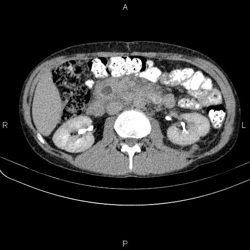 File:Autoimmune pancreatitis (Radiopaedia 84925-100431 Axial C+ delayed 34).jpg